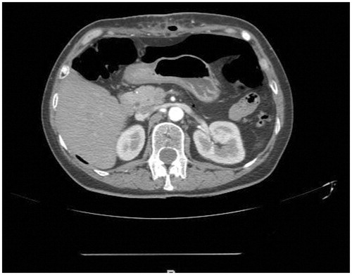 Figure 3. Abdominal CT scan confirming supra-mesocolic and subdiaphragmatic free endoperitoneal gas, compatible with an intestinal perforation.