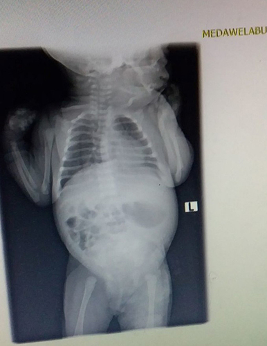 Figure 3 Plain abdominal x-ray showing absence of air shadow in the rectum.