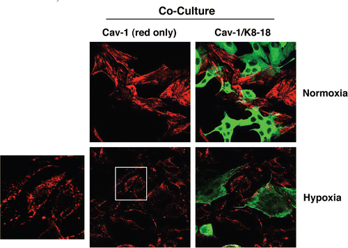 Figure 2 Hypoxia induces Cav-1 downregulation in co-cultured fibroblasts. hTERT-fibroblast-MCF7 co-cultures were placed in hypoxia (0.5% O2) or normoxia (21% O2) for 3 days. Then, cells were fixed and immuno-stained with anti-Cav-1 (Red) and anti-K8-18 (Green) antibodies. Cav-1 staining (red only) is shown on the left to better appreciate hypoxia-induced Cav-1 downregulation. Note that during hypoxia, Cav-1 is localized to intracellular vesicles. The boxed area is shown enlarged on the left to illustrate that Cav-1 accumulates in intracellular vesicles, consistent with an autophagic/lysosomal degradation mechanism. Original magnification, 40x.
