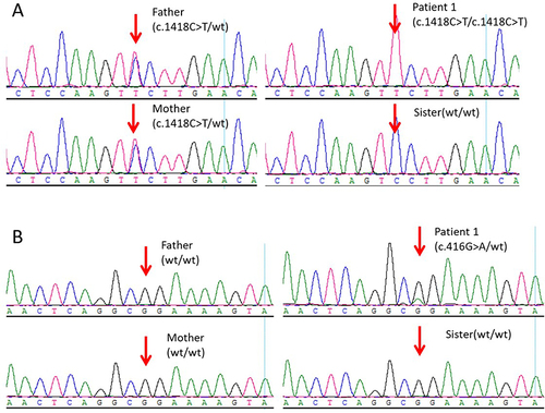 Figure 1 Sanger sequencing for validation of the variations detected by the next-generation sequencing platforms. (A) ATP6V0A4 c.1418C>T variant in family members of Individual 1. (B) POU1F1 c.416G>A (p. Arg139Gln) variant in family of Individual 1.