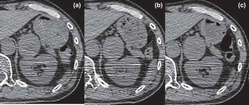 Figure 3. Examples of the daily CT images acquired prior to beam delivery for image guidance in setting the isocenter of SBRT. (a) First treatment. (b) Fourth fraction. (c) Eighth fraction. Forms of the stomach changed slightly from day to day, but the position of the posterior wall bordering the left adrenal grand on all days seemed to remain constant.