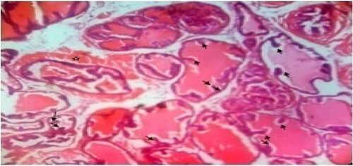 Figure 5. Mid dose: Photomicrograph of dorsal prostate tissue showed extensively enlarged acini with reduced secretory (star) materials in the lumen. The hyperplastic condition (black arrow) was also observed. H&E. mag. 400×.