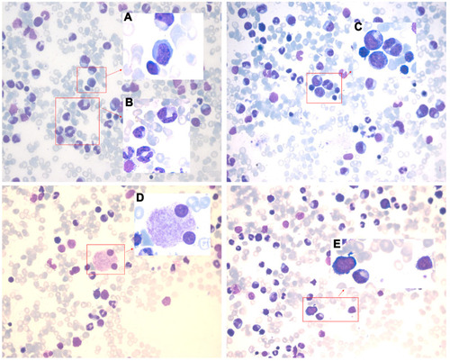 Figure 1 Bone marrow images at the first admission. Pathological change with multi-lineage myelodysplasia, including erythropathy (megaloblastic changes, (A)), granulocytopathy (rod thickening of neutrophils, (B); binuclear, (C)), megakaryocytopathy (binuclear, (D)) and blasts (E).
