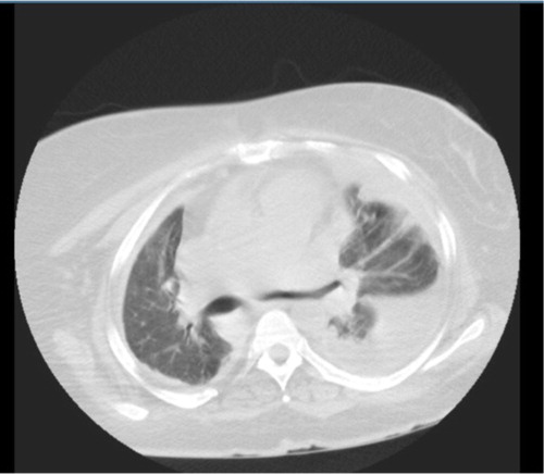 Fig. 2 Chest CT (lung window) at the level of tracheal bifurcation showing left lung effusion.