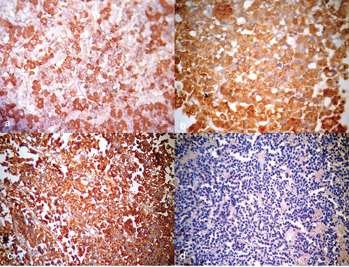 Figure 4. Photomicrographs of pituitary tissue showing (a) positive cytoplasmic staining with growth hormone monoclonal antibody in normal pituitary gland [Positive GH Immunostain x 400], (b) positive cytoplasmic staining with growth hormone monoclonal antibody in pituitary adenoma [Positive GH Immunostain x 400], (c) positive cytoplasmic staining with prolactin hormone monoclonal antibody in pituitary adenoma [Prolactin Immunostain x 400] and (d) negative cytoplasmic staining in pituitary adenoma [Negative immunostain for all six antibodies x 400].