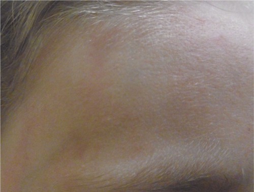 Figure 12 Recovery after 4 weeks of tested topical cream.