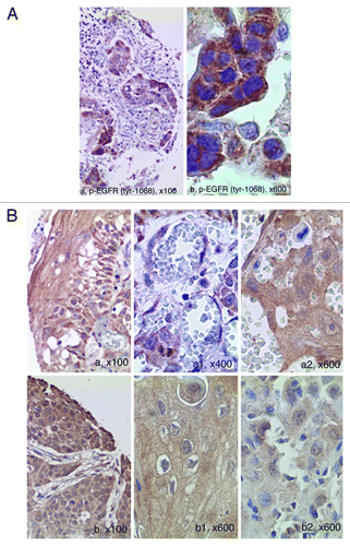 Figure 2.  Phosphorylated EGFR-p-tyr1068 and p-tyr845 in oral cancer as evaluated by TMA-based immunohistochemistry. (A) A TMA core of positive p-EGFR-tyr 1068 is showed in (A), at larger magnification in (B), demonstrating strong cytoplasmic expression of the activated receptor (LSAB-HRP, nuclear counterstaining with haematoxylin). (B) Phosphorylation of EGFR on Tyrosine 845 in oral cancer as evaluated by TMA-based IHC. A, A1, A2 show high cytoplasmic expression of p-845 EGFR in a representative case of OSCC with vascular invasion. B, B1, B2 show p-845 EGFR in a case of OSCC with poor differentiation (A, A1, A2, B, B1, B2: IHC- LSAB-HRP, nuclear counterstaining with haematoxylin; phosphorylated tyr845 EGFR Ab).
