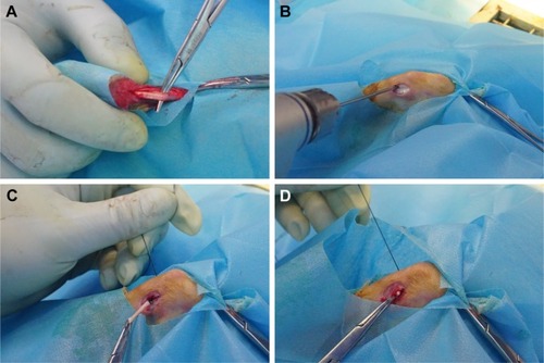 Figure 1 Animal surgery procedure.Notes: (A) Partial-thickness Achilles tendon of one hindlimb was harvested. (B) The bone tunnel was made in the proximal tibia of the other hindlimb. (C, D) The Achilles tendon graft was passed through the bone tunnel.