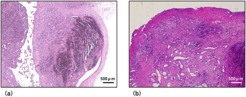 Figure 5. Histopathological findings. Hematoxylin-eosin stained images at 40x magnification. Scale bar = 500 µm. (a) Pathological findings for the lesion. The three-layered structure of the arterial wall was disrupted, consistent with the finding of a pseudoaneurysm. (b) Pathological findings of one region of the lesion. Capillary dilation and edematous stromal hyperplasia were observed, which were characteristic of pyogenic granuloma.