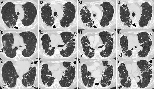 Figure 2 Chest computed tomography (CT) findings during the clinical course. (A–C) At referral, multiple cavitary lesions (white arrowheads) are in both lungs with bronchiectasis (black arrows) in lingula. (D–F) At the diagnosis of rheumatoid arthritis (RA), cavitary lesions and bronchiectasis are worsening. (G–I) At the introduction of abatacept, no change has occurred in the cavitary lesions in the left lung or bronchiectasis in bilateral fields. (J–L) One year after the introduction of abatacept, cavitary lesions partially improved, whereas a new small cavity has developed in the right lung.