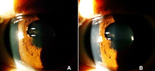 Figure 2 (A) Koeppe nodules (arrows) in a patient with exacerbation of JIA-related uveitis. (B) Same patient after treatment. The Koeppe nodules had disappeared (arrows points were the nodules were before treatment) but posterior synechiae persisted.