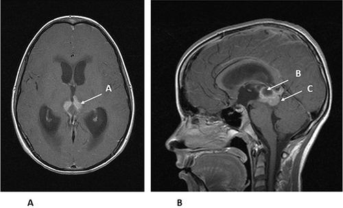 Figure 5 (A) Axial MRI with gadolinium of the same 14-year-old from Figure 3. The enhancing tumor (A) is extending towards the thalamus. (B). Sagittal MRI with gadolinium of the same 14-year-old showing the enhancing tumor (B) and a cyst within the tumor (C). The patient had an endoscopic third ventriculostomy with biopsy to confirm the diagnosis of germinoma and treat his hydrocephalus. He was then treated with chemotherapy, followed by local radiation therapy.