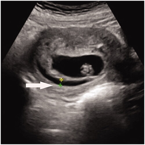 Figure 1. Subchorionic haematoma in the first trimester. A hypoechoic crescent-shaped area separates the uterine wall and chorion (arrow).