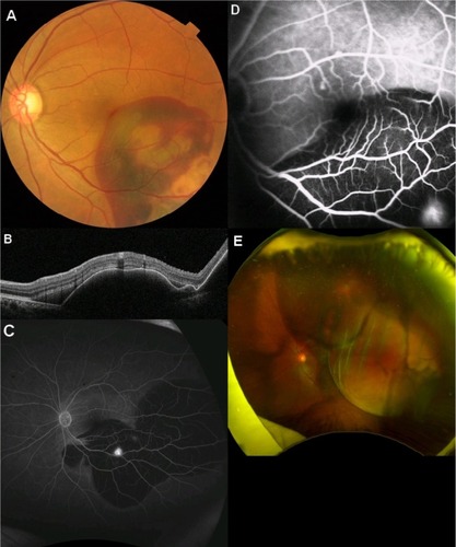 Figure 1 Massive subretinal hemorrhage and vitreous hemorrhage due to PCV in the left eye.