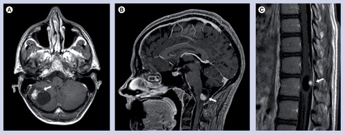 Figure 1. Imaging characteristics of hemangioblastomas.Postcontrast T1-weighted MRIs of (A) a cerebellar, (B) brainstem and (C) spinal cord hemangioblastoma. Arrows in each image indicate the location of the hemangioblastoma mural nodule, with its associated peritumoral cyst.