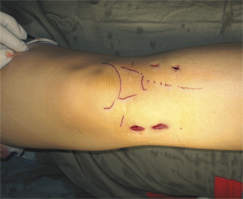 Figure 5. The wounds for Case 3, a patient with a giant cell tumor of the proximal tibia. The two wounds on the medial side served as working portals, while those on the lateral side were used for pin-insertion of the patient tracker.