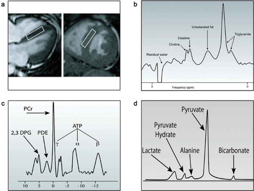 Figure 3. Cardiac magnetic resonance spectroscopy.A, Four chamber and short axis magnetic resonance image of a human heart. The white square depicts the spectroscopic volume that is typically placed in the intraventricular septum to reduce motion artifacts. B, Typical 1H spectrum of the intraventricular septum. Because water is the most abundant substance, the images are acquired after a water suppression pulse. C, Typical 31P magnetic resonance spectrum of the left ventricle. D, Typical 13C spectrum of the pig heart obtained after infusion of a hyperpolarized 1-13C pyruvate tracer. ATP: adenosine triphosphate; 2,3 DPG: 2,3-diphosphoglycerate; PDE: phosphodiesters; PCr: phosphocreatine. Adapted by permission from BMJ Publishing Group Limited. [Metabolic imaging of the human heart: clinical application of magnetic resonance spectroscopy, HJ Heart Br. Card. Soc., Bizino MB, Hammer S, Lamb, 100:881–890, 2014.] [Citation86].