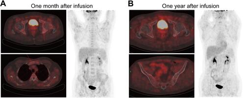 Figure 3 Computed tomography and positron emission tomography images one month (A) and one year after murine monoclonal anti-CD19 and anti-CD22 CAR T-cell “cocktail” infusion (B).
