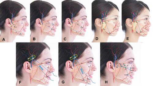 Figure 4 Landmarks of the different insertion techniques based on the principal direction of the repositioning vectors.Citation14 The Lateral Vector (LV) techniques are typically used in Caucasian facial types and include the: (A) Jawline Reshaping (JR), (B) Malar Reshaping (MR) and (C) Lateral Reshaping (LR) techniques. The Vertical Vector (VV) techniques are mostly used in Asian facial types and include the: (D) Oval Reshaping – H technique (OR-H) and the (D) Oval Reshaping – Vertical technique (OR-V). The Anti-Gravity Reshaping (AGR) techniques may be used for large areas of ptosis and include the (F) Malar (AGR-M) and (G) Jawline (AGR-J) technique. The Soft Tissue Reshaping (STR) technique (H) is used to create more volume in the malar area.