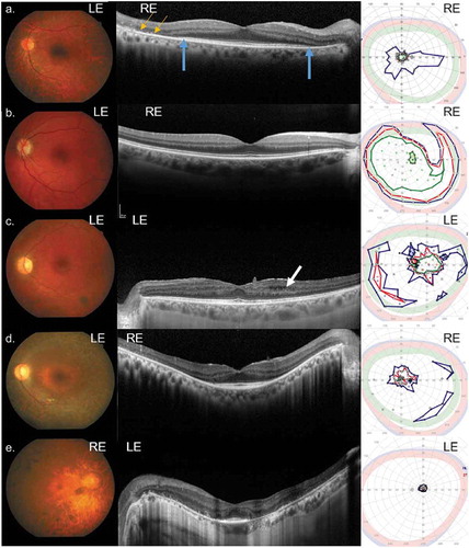 Figure 3. Color fundus images (left panel), SD-OCT horizontal line scans through the fovea (middle panel), and kinetic visual fields (right panel) for families A-E. (a) Patient A1; (b) Patient B3. (c) Patient C1 had cystoid macular edema (arrow) noted on SD-OCT. (d) Patient D1. (e) Patient E1. SD-OCT image on same eye as the kinetic visual field. Right eye, RE; Left eye, LE; blue isopter, spot size V4e; red isopter, spot size III4e; green isopter, spot size I4e