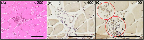 Figure 3. H&E and immunochemical tissue staining of muscle biopsies from patients with PM/DM H&E and immunohistochemical staining of muscle biopsies from patients with myositis (PM, n = 2; DM, n = 2). The muscle biopsies from patients with DM. (A) H&E staining. (B, C) Immunohistochemical staining of inflammatory cell infiltration sites. (B) Normal goat IgG was used as the control. Inflammatory cell infiltration was observed in the interstitium but was not stained in slice (B). (C) Immunohistochemical staining of the inflammatory cell infiltration sites. Slices at the same level as (B) were stained with goat anti-human YKL-40 antibody. YKL-40-positive inflammatory cell infiltrates were observed in the stroma (red circles). Magnification: (A) ×200, (B) ×400 and (C) ×400. Bar, 100 μm. DM: dermatomyositis; H&E: haematoxylin–eosin; PM: polymyositis.