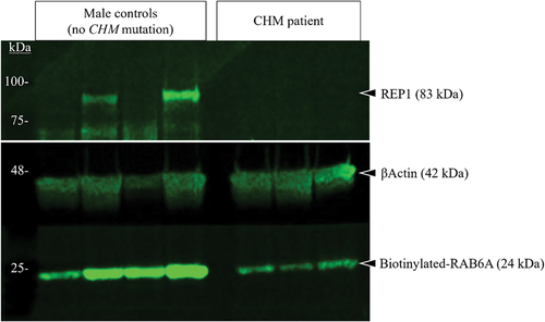 Figure 4. Analysis of REP1 protein expression and function in the CHM patient. Four different samples from healthy donors (no CHM gene mutation) were included in this assay. While REP1 expression was not detected in two of the controls, the four samples show a high concentration of biotinylated RAB6A compared with the patient, which indicates a high prenylation activity in controls. Three technical replicates were conducted with patient’s samples. REP1 protein expression is not detected in the patient carrying the c.1350-3C>G mutation. However, a 24 kDa band corresponding with biotinylated RAB6A is detected in the patient’s samples, which suggests that some residual prenylation activity is present. The 42 kDa band corresponding to the βActin, used as the loading control, is detected in all the samples.