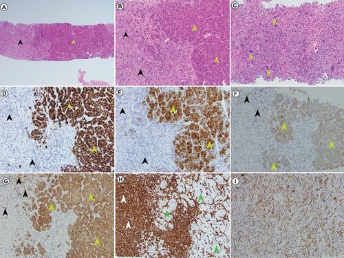 Figure 2. Histologic and immunophenotypic findings of sarcomatoid hepatocellular carcinoma as seen on the diagnostic biopsy.(A) At low magnification, the biphenotypic histology of sarcomatoid and conventional hepatocellular components is evident in the patient’s core needle biopsy specimen (green arrow head – conventional HCC component; black arrowhead – sarcomatoid component) (H&E 40× magnification). (B) Higher magnification shows widened plates of neoplastic hepatocytes (green arrowheads) and adjacent areas of spindled and bizarrely shaped sarcomatoid cells (black arrowheads) (H&E 100× magnification). (C) Higher magnification of sarcomatoid component with bizarre multinucleated giant cells (green arrowheads) (H&E 200× magnification). (D) The conventional HCC component (green arrowheads) is positive for HepPar1 IHC stain but the sarcomatoid component (black arrowheads) is negative (100× magnification). (E) The conventional HCC (green arrowheads) is positive for arginase 1 IHC stain but the sarcomatoid component (black arrowheads) is negative (100× magnification). (F) The conventional HCC (green arrowheads) is positive for cytokeratin CAM5.2 IHC with patchy positivity seen in the sarcomatoid component (black arrowheads) (100× magnification). (G) The conventional HCC is positive for cytokeratin AE1/AE3 IHC (green arrowheads) with patchy positivity seen in the sarcomatoid component (black arrowheads) (100× magnification). (H) The absence of staining for vimentin in the conventional HCC component (green arrowheads) stands in sharp contrast to the strong positivity of the sarcomatoid component (white arrowheads) (100× magnification). (I) Patchy positivity for cytokeratin AE1/AE3 present in this area of tumor only displaying sarcomatoid features is seen (100× magnification).H&E: Hematoxylin and eosin; HCC: Hepatocellular carcinoma; IHC: Immunohistochemical.