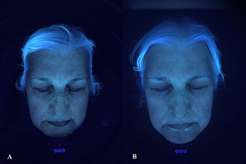 Figure 1 Positive change in dark-circle and wrinkle status at PA1 (A) and PA4 (B) in wood light mode.