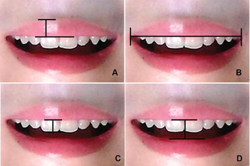 Figure 1 Quantitative indicators. (A) Upper labial height; (B) outer intercommissural width; (C) the upper central incisors display; (D) interlabial gap.