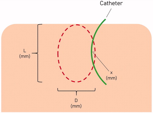 Figure 2. Diagrammatic illustration of how each microwave ablation zone was measured. L: Length; D: Diameter.