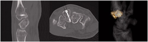 Figure 6. Postoperative computed tomography images obtained at one year after surgical fixation of an isolated left trapezoid coronal shearing fracture in a 40-year-old male. Complete bone union of the trapezoid is visible without any arthritic changes of the second carpometacarpal joint or necrosis of trapezoid. The headless compression screw does not protrude out of the bone. There is no step in the joint and no separation at the fracture site.