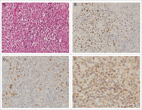 Figure 8. Pattern of expression of EBNA2, LMP1 and LC3 in a case of EBV-positive latency III lymphoproliferation. Immunohistochemical staining obtained from tonsil biopsy. Panels are representative of images taken at 25x (A, B and C) or 40x magnification (D). (A) hematoxylineosin-Safran staining. (B) EBNA2 nuclear staining. (C) LMP1 cell membrane staining. (D) cytosolic LC3 staining with visible puncta.