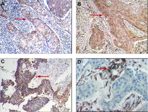 Figure 4 (A) Immunohistochemical staining for positive expression of VEGF. The cytoplasm of tumor cells was stained brown (red arrows). (A) VEGF(+)(SP × 100), (B) VEGF(++)(SP × 100), (C) VEgF(+++)(SP × 100), and (D) positive expression of CD34. Vessels were stained brown and high microvessel density was apparent (SP × 200).