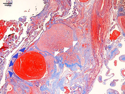 Figure 4 Pathologic specimens (Masson stain 4x) of our representative case of a 54-year-old man with MT in left buccal space. On the pathologic specimen from surgery a mass containing vessel of dilatated small calibre (white triangles) was seen in addition to a thrombus (purple triangles) and anastomosing network of little vessels, some fibrous septa and muscular fibers around the lesion.
