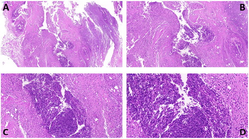 Figure 8. Histopathological histology of synovial tissue after ablation showing necrosis of synovial tissue. 5× (A), 10× (B), 20× (C), 40× (D).
