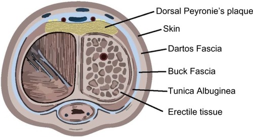 Figure 1 Cross-sectional view of a penis with a dorsally located plaque.