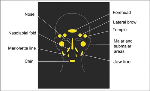 Figure 1 Individual facial treatment areas using the PCL-based stimulator.