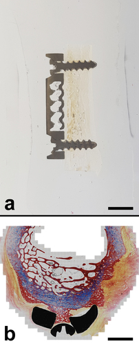 Figure 2. (a) A 200 µm thick section of a titanium miniplate fixed to a cadaveric sheep mandible using two 2 mm × 8 mm titanium screws. A section was glued to a microscopic slide using a highly viscous industrial grade UV-activated acrylic glue (Viscosity @ 25 ℃ @ 20 RPM: 30,000 to 55,000 mPa.S) resulting in the entrapment of several air bubbles in between the section and the slide. Miniplate was designed and kindly supplied by MAXONIQ. Scale bar = 5 mm. (b) Stitched photomicrograph of a transverse section through the distal metaphysis of a sheep femur. Section has been obtained at the level of the flange of a titanium prosthesis implanted 12 weeks earlier. Masson–Goldner Trichrome staining. Courtesy of IMCRC Just-in-time patient-specific bone tumour project. Scale bar = 5000 µm.