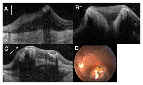 Figure 2 Spectral-domain optical coherence tomography scans of the left eye. (A) Longitudinal scan of the tumor. The round hyper-reflective mass accompanied by serous retinal detachment and disappearing posterior optical shadowing projected strongly upward from the choroid and partially broke through into the retina. Note the lamellar reflective pattern in the subretina and the disorganized structure of the retina with loss of inner and outer retinal layers. (B) Longitudinal scan of the tumor. There is a curved hyper-reflective mass similar to the finding in (A). (C) Skewed scan of the tumor. The raised hyper-reflective mass, a mound-like area, is observed in decalcified regions. (D) Fundus photograph for scan marking.