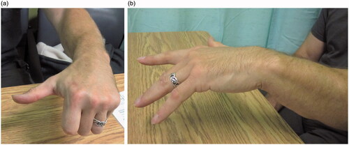 Figure 7. (a) Thumb extension at 1.5 years postoperatively. (b) Finger extension at 1.5 years postoperatively.