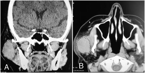 Figure 1. Computed Tomography (CT) scan of the neck. Right parotid mass invading neighboring muscle. The parotid mass is encircled with black dots. (A) Coronal axis. (B) Axial axis.