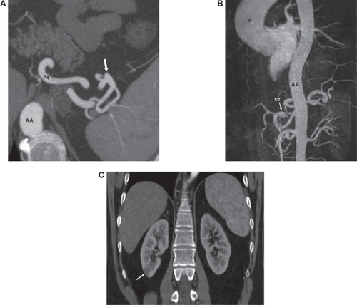 Figure 3 A) Axial contrast-enhanced computed tomography scan through upper abdomen shows a small aneurysm (arrow) of the splenic artery (SA). B) Magnetic resonance angiography (MRA) image showing celiac trunk dissection (CT) and an ascending aorta (A) dilatation of 4.9 cm. Normal widely patent abdominal aorta (AA) shows no evidence of dissection. C) Coronal reformatted computed tomography image shows right renal infarct (arrow).