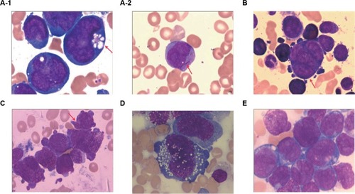 Figure 1 BM morphologic features.Notes: (A-1) (Case 7): Blasts are large with multiple and irregular nuclei and large nucleoli; cytoplasm is dark blue and filled with granules and prominent cytoplasmic vacuoles (arrow). Peripheral blood (A-2) (Case 7): Auer rod (arrow). (B) (Case 9): Blasts are different in size with pleomorphic nuclei and prominent nucleoli. Multinucleate blasts (arrow). (C) (Case 10): Blasts are different in size and filled with granules and prominent cytoplasmic pseudopodia. Faggot cell (arrow). (D) (Case 3): Atypical large blasts with irregular nuclear outlines and frequent cytoplasmic vacuoles, showing large nuclei and nucleoli. (E) (Case 2): Blasts are large with prominent, multiple, and pleomorphic nuclei. Magnification ×1000.Abbreviation: BM, bone marrow.