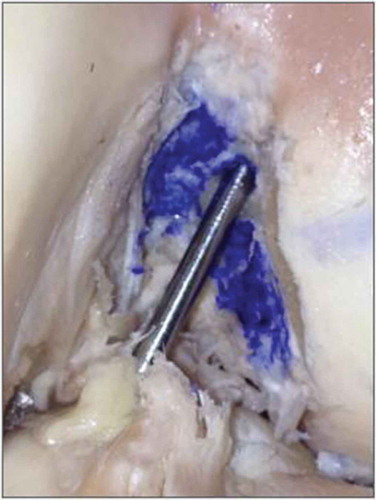 Figure 1. Guidewire passing between the anteromedial and posterolateral bundles of the ACL.Source: Anatomy Laboratory–UNIRIO, 2015.