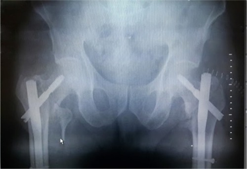 Figure 3 Postoperative X­ray showing bilateral proximal femoral nail implementation.