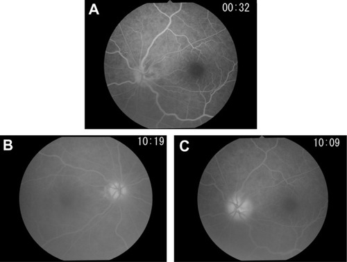 Figure 2 Fluorescein angiography performed at onset.