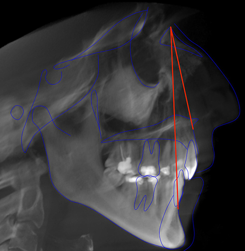Figure 2 A CBCT-derived lateral cephalogram showing ANB angle.