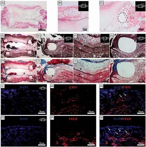 Figure 7. Histological results for the haematoxylin-eosin–stained sections two weeks after orthotopic scaffold implantation. (A) At the end of the second week, a PCL with reinforcement rings could be identified. The artificial oesophagus constructs showed healing of the circumferential defects by the second week. The fusion of the PCL scaffold and regenerative tissue was intact. Mild inflammatory reactions and minimal granulation tissue formation were observed. (B) Several newly developed blood vessels in the outer side of the scaffold indicated tissue regeneration. The structural integrity was maintained by the alignment of infiltrated host cells into the scaffold. The dotted line represents the boundary between the omentum-cultured scaffold and the regenerated tissue covering the scaffold. (C) Squamous epithelium and soft-tissue regeneration occurred at the periphery of the oesophageal defect. Histological analysis for the Verhoeff's van Gieson Stain (D, E, F, G) and Masson's trichrome (H, I, J, K) sections two weeks after implantation. Elastin (arrows in E and F) and collagen (arrows in H, I, and J) fibre deposition were observed in all parts of the artificial oesophagus with layered structure. The tissue regeneration originated from the natural oesophagus and connected to either end of the artificial oesophagus. The dotted line represents the PCL ring. Immunohistochemistry of the implanted scaffold. DAPI (4,6-diamidino-2-phenylindole) staining (L and O). Platelet endothelial cell adhesion molecule (CD31/PECAM-1) (M) and VEGF staining (P). The merged file of DAPI/CD31 (N) and DAPI/VEGF (Q) indicated that neovascularization developed in the implanted scaffold (white arrows). PCL: Poly ε-caprolactone.