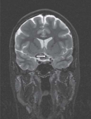 Figure 2 MRI, coronal section, T2-weighted image: the enlargement of the optical chiasm can easily be seen.