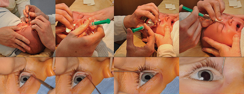 Figure 5. Lacrimal probing and syringing under local anesthesia (upper row) and general anesthesia (lower row).